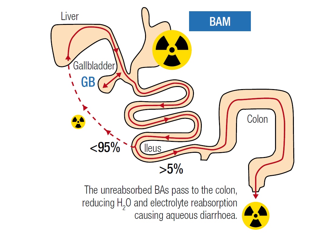 Mechanism of Bile Acid Diarrhoea GE Healthcare